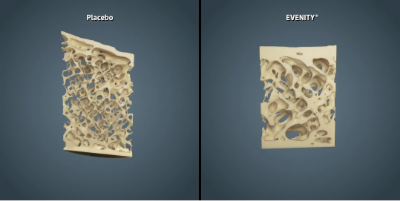 EVENITY 3D Bone Model