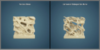 Prolia 3D Bone Model