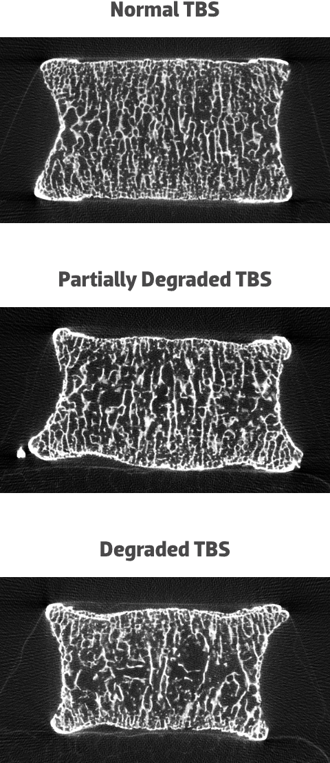 Example of three categories of trabecular bone score (TBS)